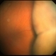 Choroidal Detachment Choroidal Detachment