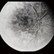 Pattern Dystrophy
