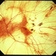 Choroideremia Choroideremia