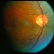 Multiple Vitelliforn Retinal 7