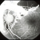 Thick Subretinal Hemorrhage 7 Thick Subretinal Hemorrhage 7