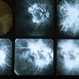 Inflammation Inflammation