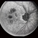 Pattern Dystrophy