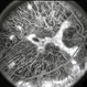 Choroideremia Choroideremia