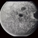 Pattern Dystrophy