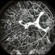 Choroideremia Choroideremia