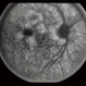 Pattern Dystrophy