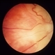 Toxocara Canis