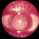 Asteriod Hyalosis Asteriod Hyalosis
