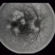 Pattern Dystrophy
