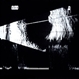 Choroidal Hemangioma Choroidal Hemangioma