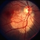 Choroidal Osteoma with CNV Choroidal Osteoma with CNV