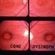 Cone Dystrophy Cone Dystrophy