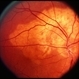 Choroidal Osteoma Choroidal Osteoma
