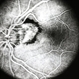 Peri-Papillary CNVM Peri-Papillary CNVM