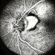 Peri-Papillary CNVM Peri-Papillary CNVM