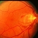 Peri-Papillary CNVM Peri-Papillary CNVM