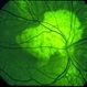 Choroidal Osteoma Choroidal Osteoma