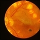 Branch Retinal Artery Occlusion