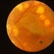 Brach Retinal Artery Occlusion Brach Retinal Artery Occlusion