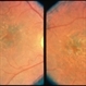 Macular Drusen Macular Drusen