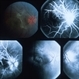 Inflammation Inflammation