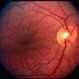 Retinal Folds Retinal Folds