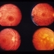 Retinal Dystrophy
