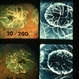 Macular Atrophy Macular Atrophy