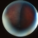 Scleral Buckle Scleral Buckle