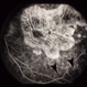 Retinal Dystrophy