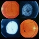 Retinal Dystrophy