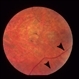 Retinal Dystrophy