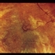 Nematode Retinitis