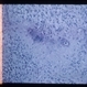Nematode Retinitis