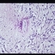 Nematode Retinitis