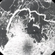 Retinal Cavernous Hemangioma Retinal Cavernous Hemangioma