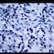 Nematode Retinitis