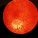 Optic Disk Coloboma Optic Disk Coloboma