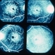 FA of Macular Drusen
