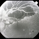 Thick Subretinal Hemorrhage 9 Thick Subretinal Hemorrhage 9