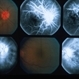 Inflammation Inflammation