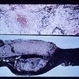 Nematode Retinitis