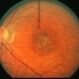 Macular Dystrophy Macular Dystrophy