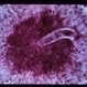 Nematode Retinitis