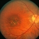 Macular Dystrophy Macular Dystrophy