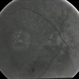 Macular Dystrophy FA Macular Dystrophy FA