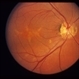 Pattern Dystrophy