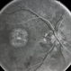 Macular Dystrophy FA Macular Dystrophy FA