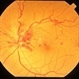 Non Ischemic Hemi-CRVO Non Ischemic Hemi-CRVO